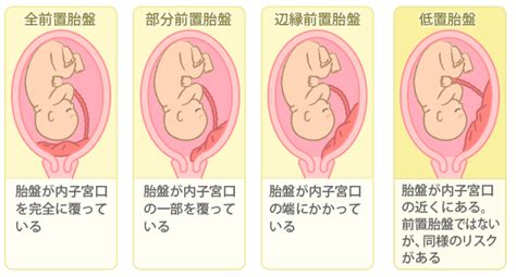 前置胎盤原因|前置胎盤とは？原因や治し方、日常生活の過ごし方、。